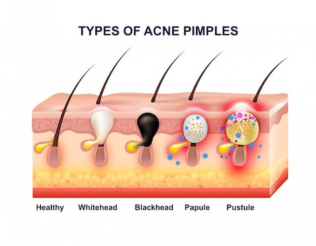 Acne Facial Treatment Singapore